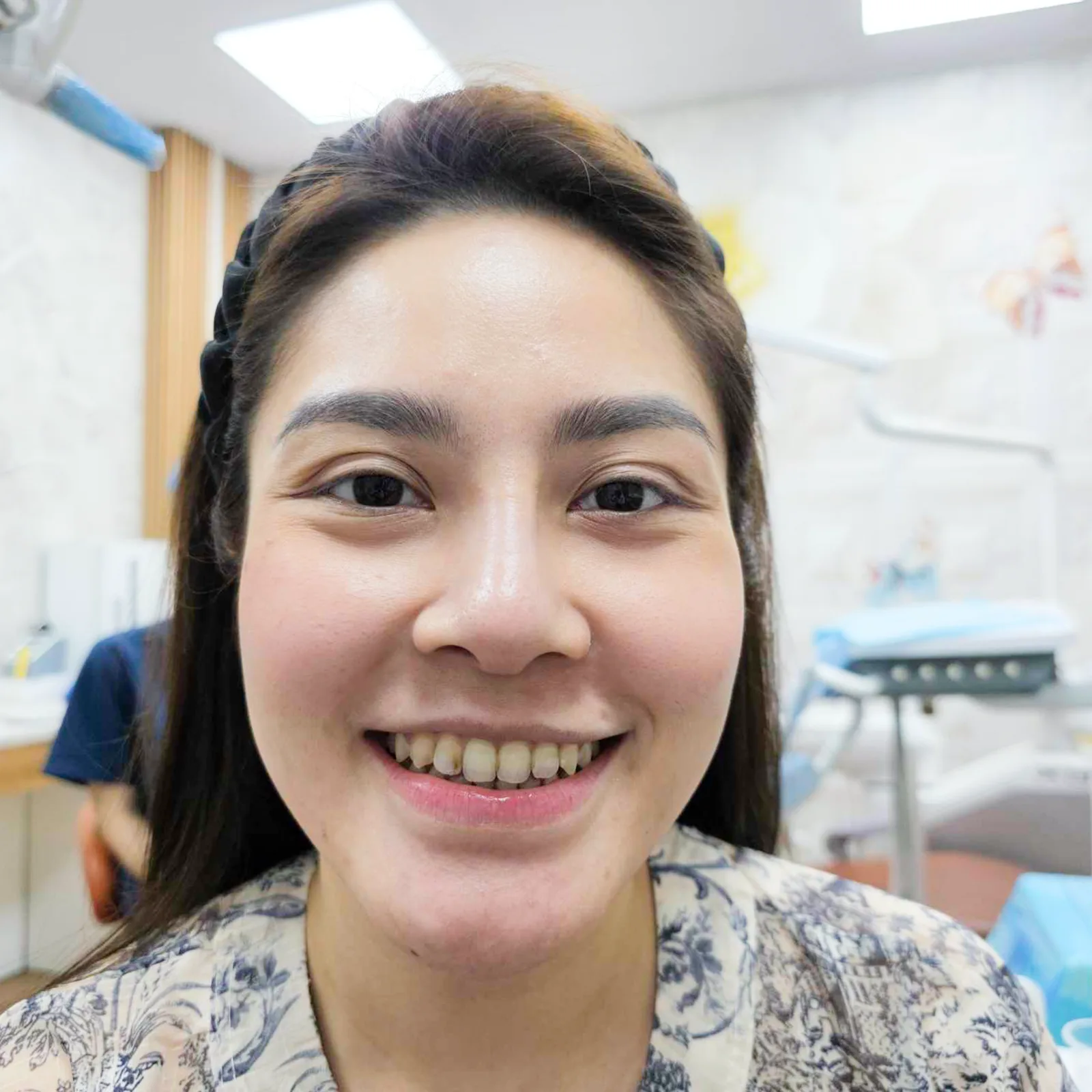 ảnh B-A khách veneer