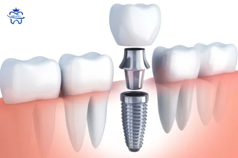 Dental Implant Placement 12 to 16 Weeks After Extraction