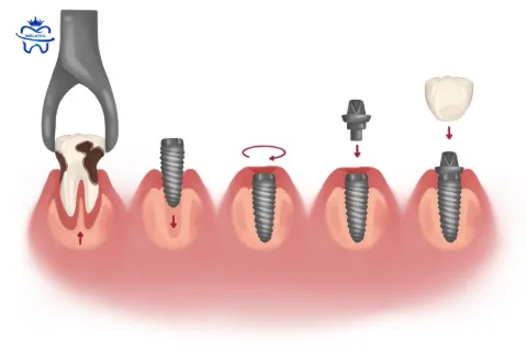 How Long Should You Wait After Tooth Extraction Before Getting an Implant?