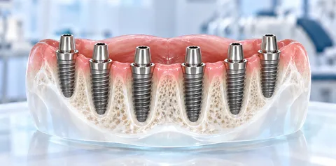 All-on-6 Implants